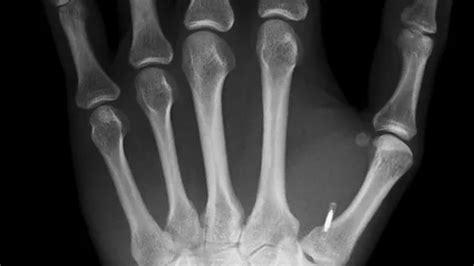 2019 taking the rfid chip to keep welfare|The surprising truths and myths about microchip implants .